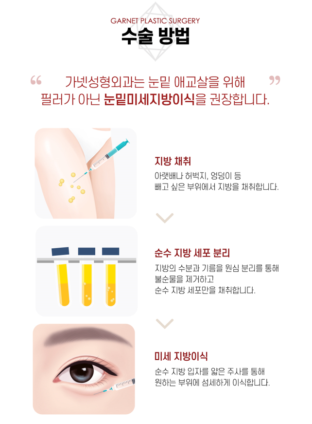 【가넷성형외과 백인수원장 성형칼럼】 애교필러 VS 눈밑 미세지방이식 관련 이미지 5