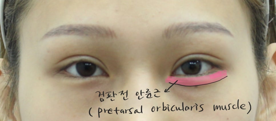 애교살 비대칭의 교정 방법 관련 이미지 3