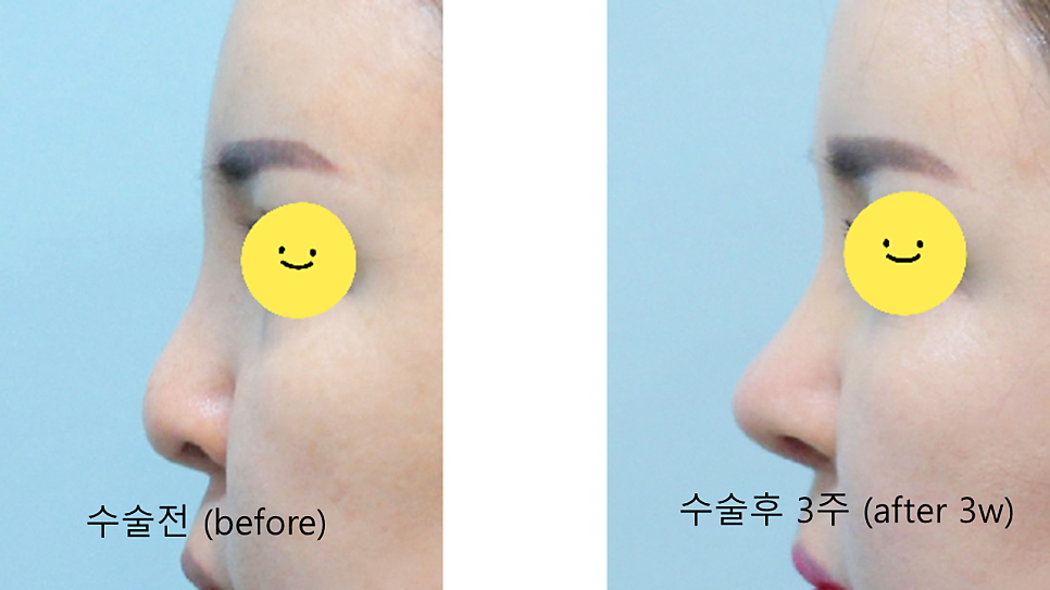 트렌드 변화에 따른 중년코 재수술 관련 이미지 9
