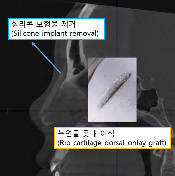 늑연골로 만든 콧대, 정말 흡수될까요? 관련 이미지 1