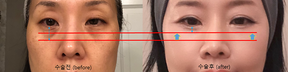 Lower Blepharoplasty in Your 50s to Add Firmness to the Midface image 6