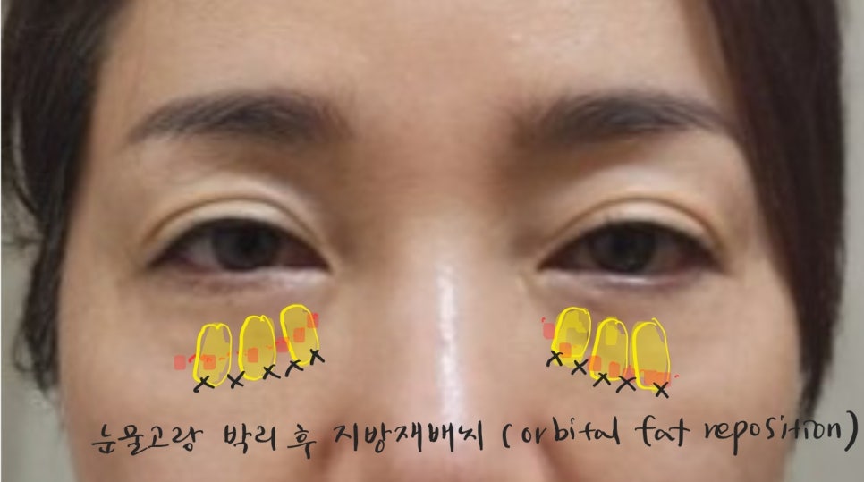 애교살을 보존하는 하안검 수술 관련 이미지 5