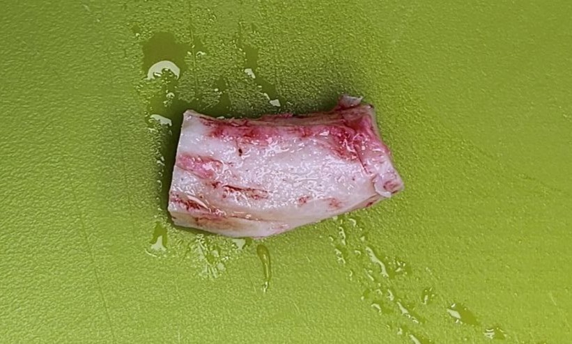 Rib Cartilage Rhinoplasty for a Deviated Saddle Nose image 5