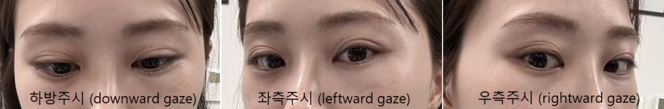 눈밑지방재배치, 복시&middot;사시는 걱정해야 할까요? (드문 부작용과 회복 과정) 관련 이미지 2