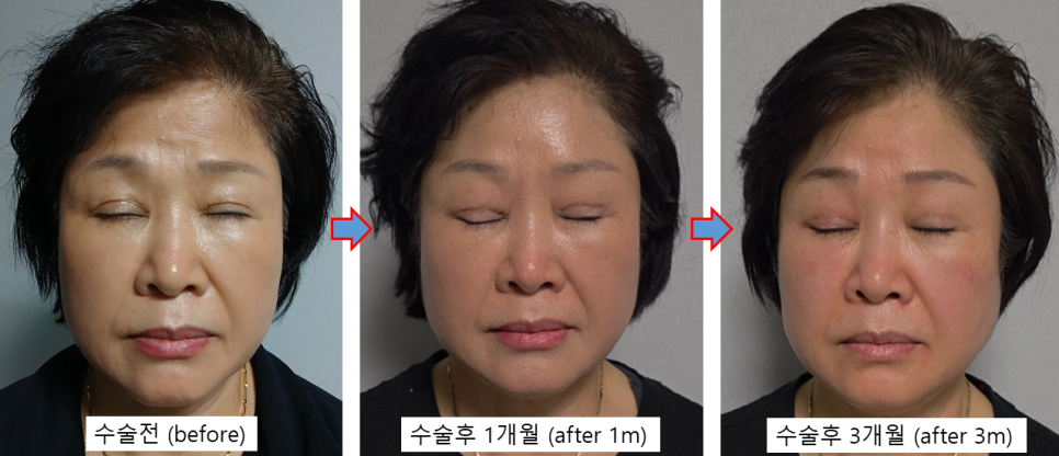 쌍꺼풀 재수술, 함몰흉터는 개선되고 눈은 편해졌습니다 - 6개월 흉터 성숙 과정 관련 이미지 3