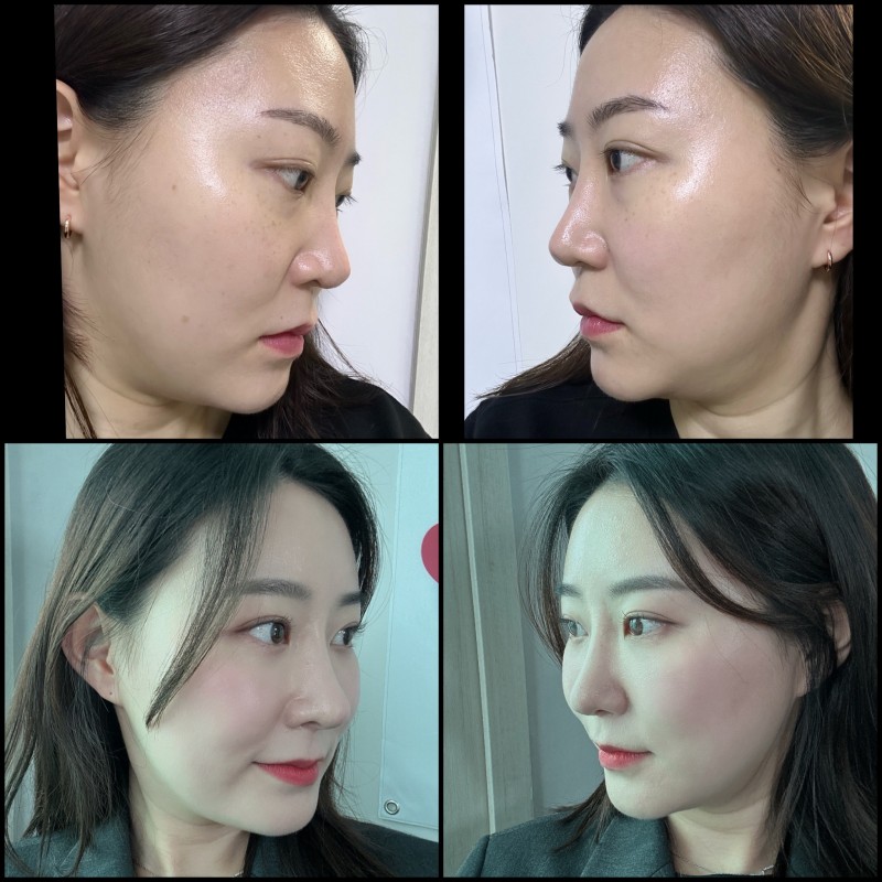 긴코 교정과 비순각 조절을 위한 코끝 리모델링 관련 이미지 9