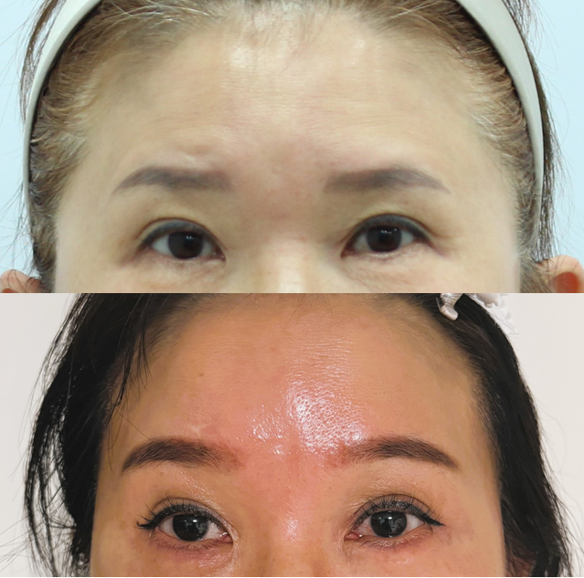 Endoscopic Forehead Lift for a Smooth Forehead image 4