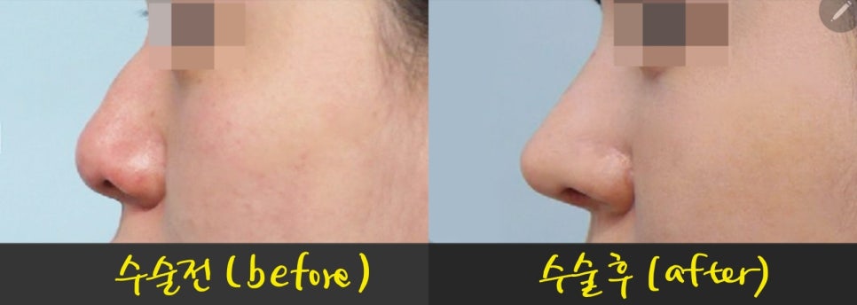 Various Nasal Tip Procedures for Bulbous Nose Correction image 8