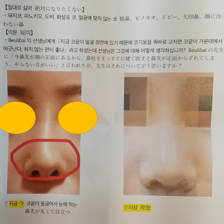 Consultation Process and Surgical Items for Revision Rhinoplasty image 3