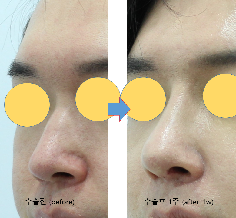 Male Rhinoplasty Performed Alongside Septoplasty image 6
