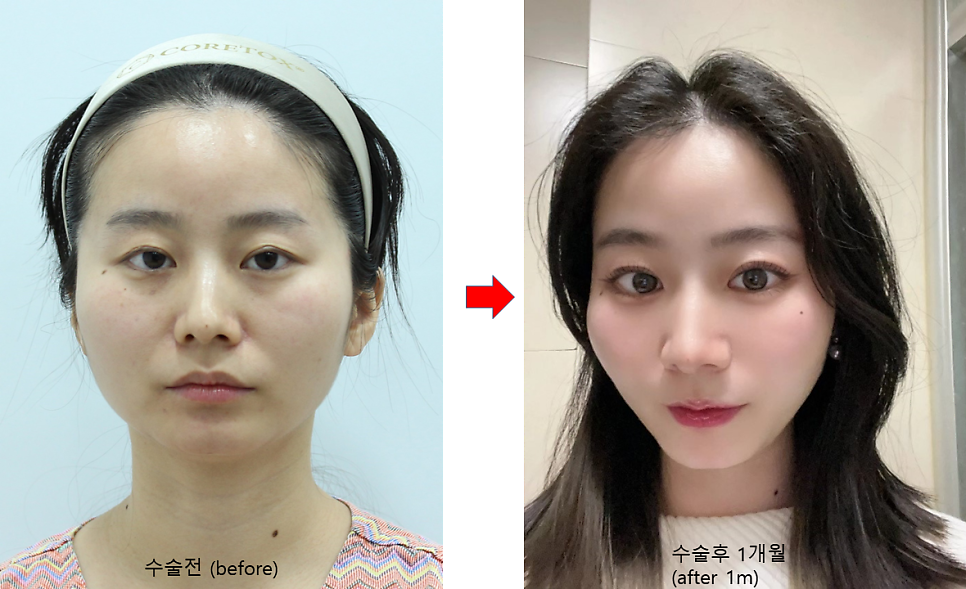 쌍꺼풀 함몰흉터를 교정하는 재수술 관련 이미지 5
