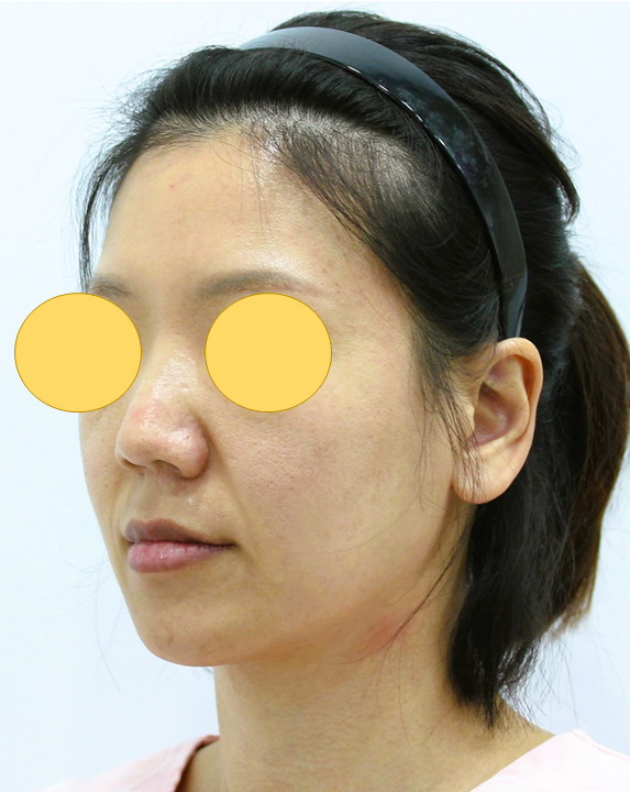 Areas of the Face Improved by a Deep Mini Facelift image 2