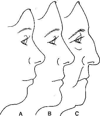 The Aging Process of the Nose and Midlife Rhinoplasty image 3