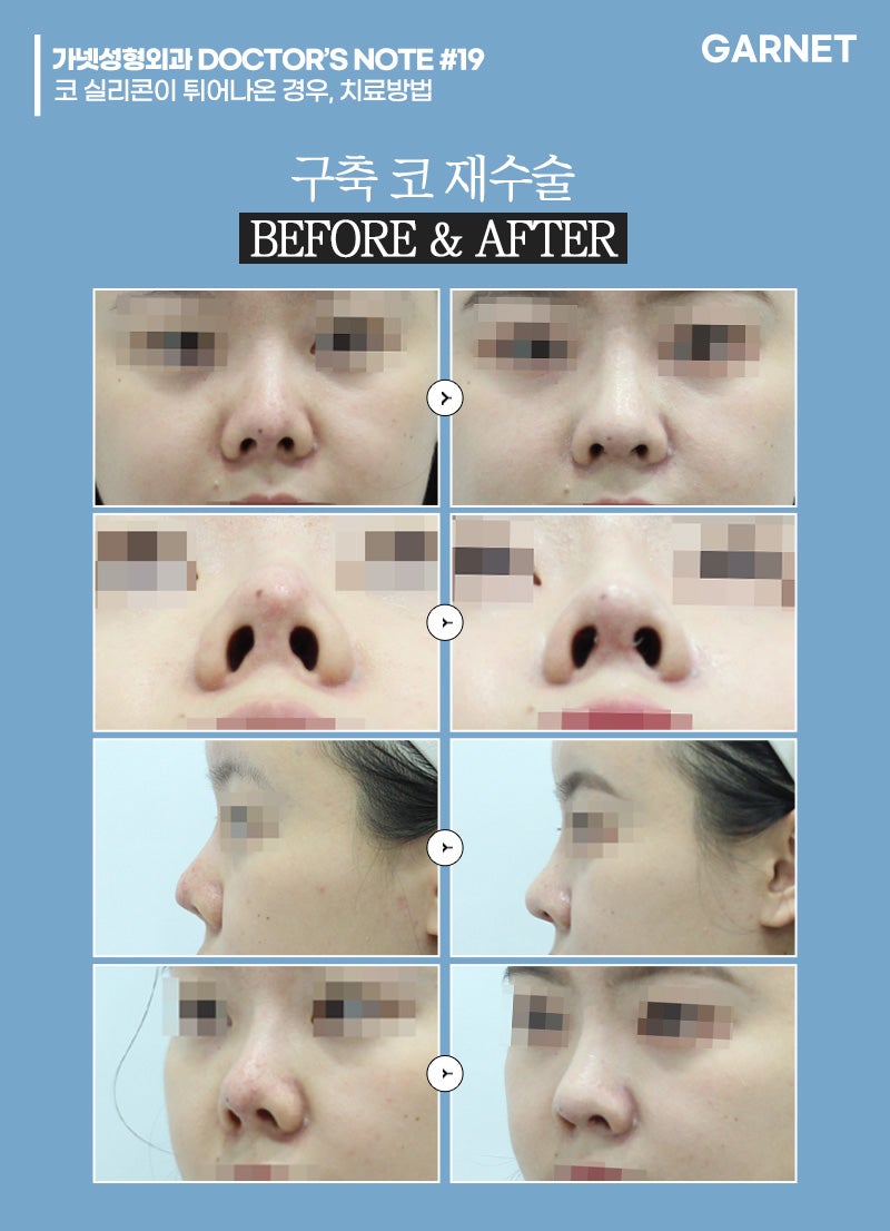 [가넷성형외과 백인수원장 성형칼럼] 코 실리콘이 튀어나온 경우, 치료방법 관련 이미지 5