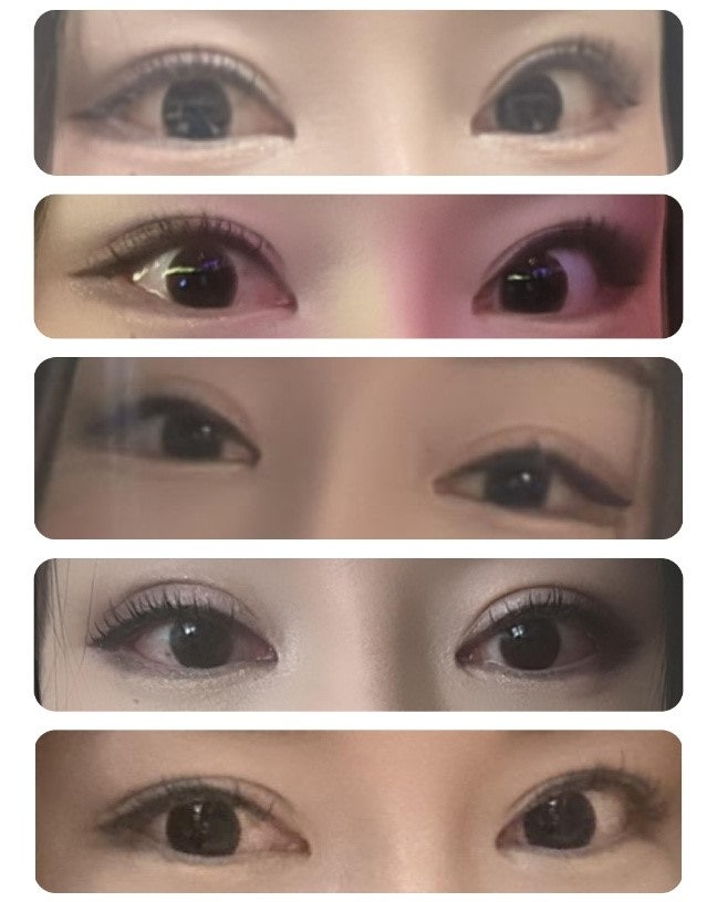 Double Eyelid Surgery and Ptosis Correction image 7