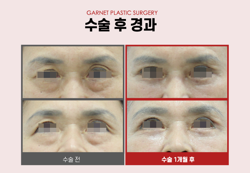 【가넷성형외과 백인수원장 성형칼럼】 60대 쿼드플러스 하안검 수술 관련 이미지 5