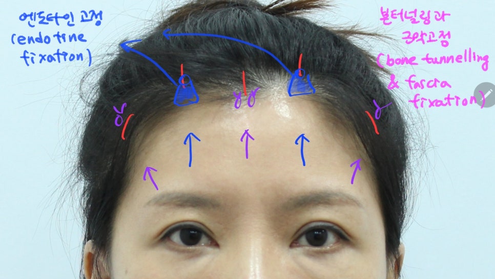 Forehead Lift After Upper Blepharoplasty image 6