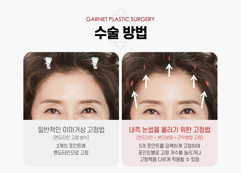 【가넷성형외과 백인수원장 성형칼럼】 20대 여성 펜타픽스 이마거상으로 이마 모양과 눈썹 교정 관련 이미지 4