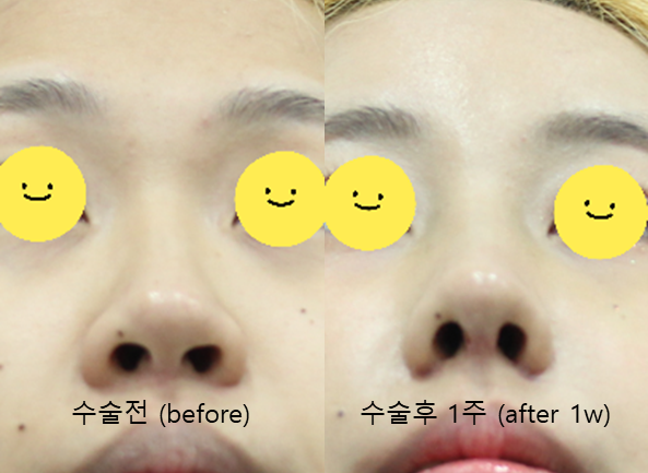 Two Methods of Nostril Reduction (Alar Reduction) image 6