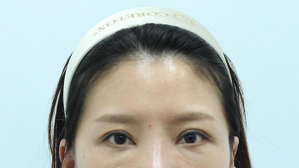 Forehead Lift After Upper Blepharoplasty image 2