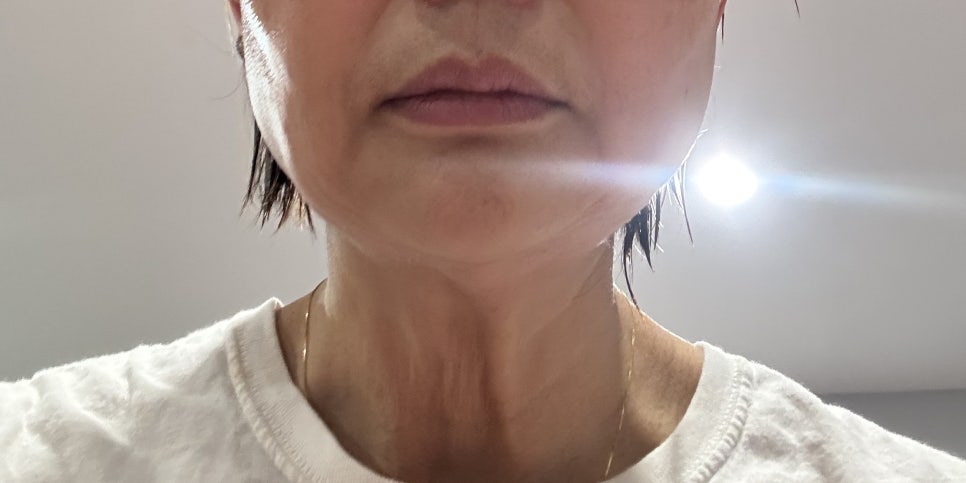 턱끝성형과 함께하는 펠리컨수술 관련 이미지 1