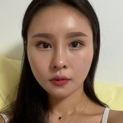 앞트임 재수술에서 윗트임의 중요성 관련 이미지 8