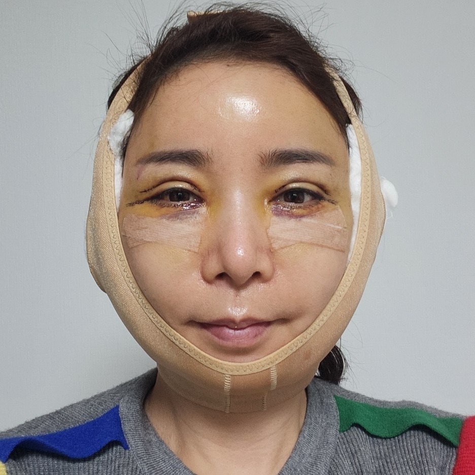 노화의 원인을 교정하는 중년성형 수술 관련 이미지 3