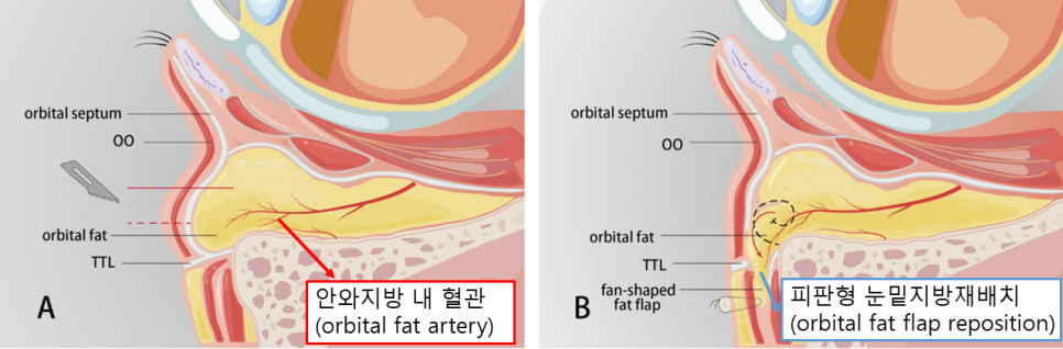 이영지 눈밑지방재배치, 시술일까 수술일까? 관련 이미지 7
