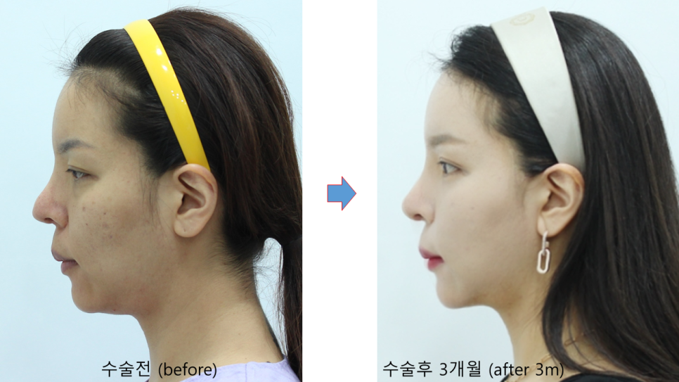 다이어트후 발생한 얼굴의 노화 관련 이미지 10