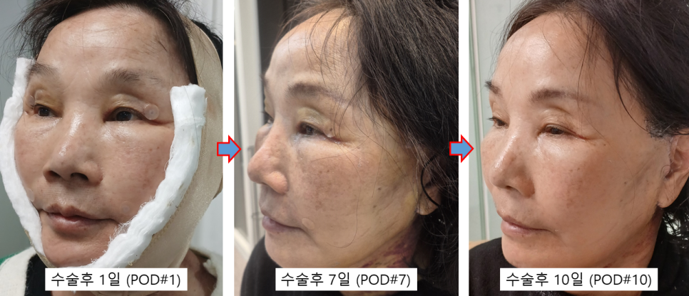 70대 안면거상 가능할까? 회복과정과 3개월 전후 실제 사례 관련 이미지 2