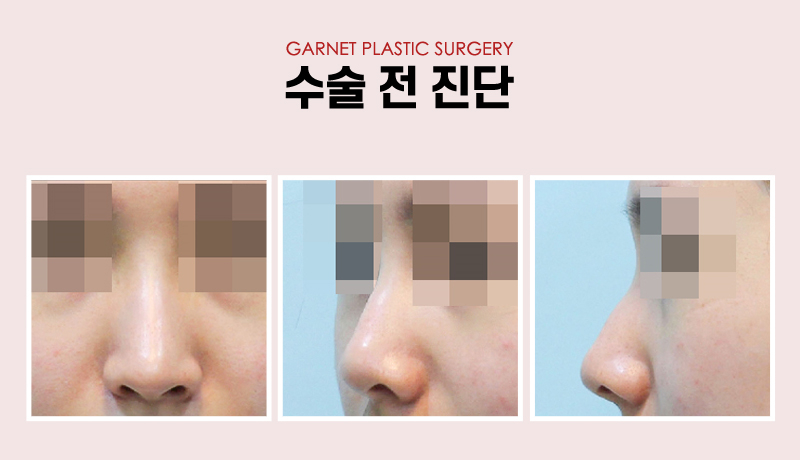 【가넷성형외과 백인수원장 성형칼럼】 매부리코 무보형물코성형 관련 이미지 3