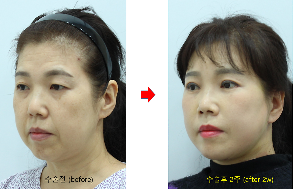 Pre- and Post-Operative Precautions for Faster Recovery After Plastic Surgery image 10