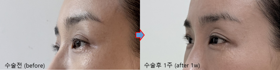 40대 후반 눈밑지방재배치, 애교살이 더 또렷해진 이유 관련 이미지 2