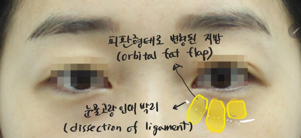The Surgical Process of Lower Eyelid Fat Repositioning image 3