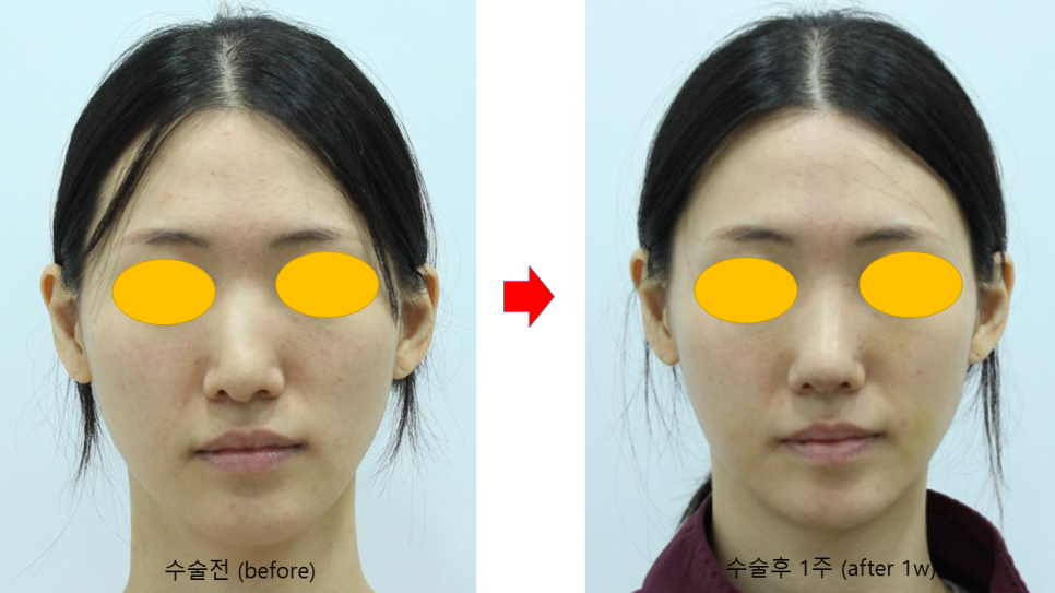Various Surgical Methods for Crooked Nose Surgery image 6