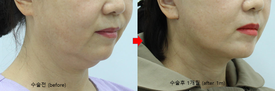 안면거상과 함께하는 목거상술 관련 이미지 7