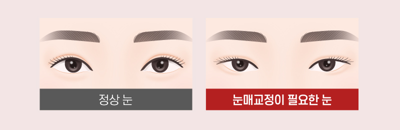 【가넷성형외과 백인수원장 성형칼럼】 쌍꺼풀재수술 (겹주름제거와 눈매교정술) 케이스 관련 이미지 5