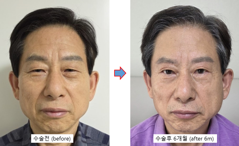 5월, 아버지께 드린 작은 변화 &ndash; 남자 눈썹하거상 관련 이미지 2