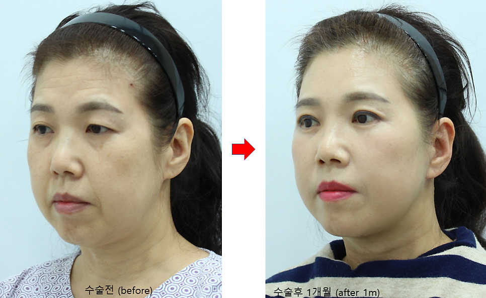 중년종합성형 상담과 수술의 범위 관련 이미지 6