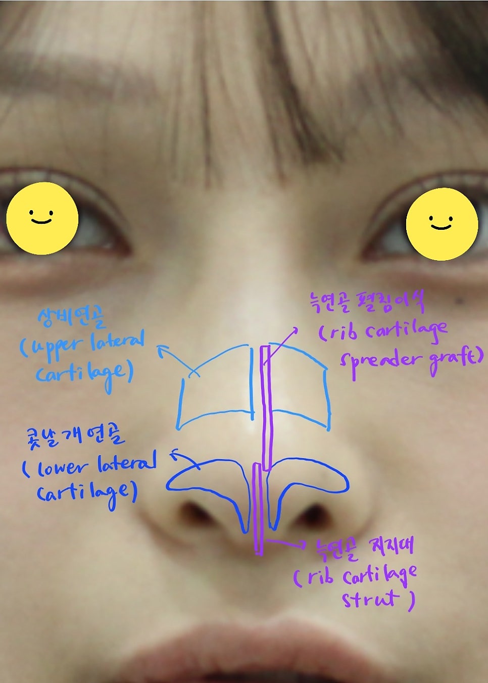 Rib Cartilage Rhinoplasty for a Deviated Saddle Nose image 7