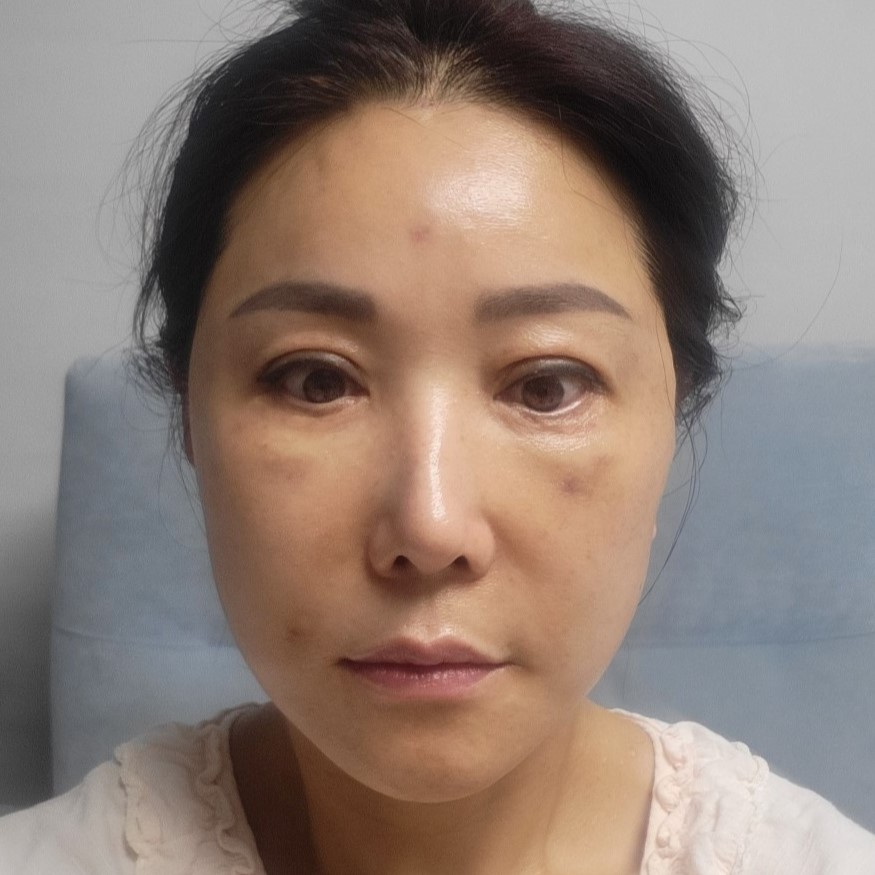 Hyperbaric Oxygen Therapy for Faster Recovery After Plastic Surgery image 8