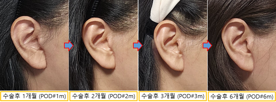 안면거상 후 흉터, 얼마나 남을까요? 흉터의 변화와 관리법 관련 이미지 5