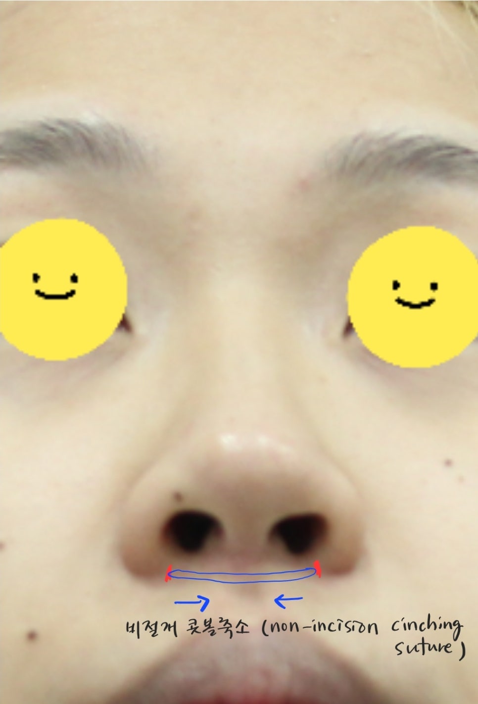 Two Methods of Nostril Reduction (Alar Reduction) image 2