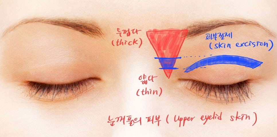 Forehead Lift After Upper Blepharoplasty image 4