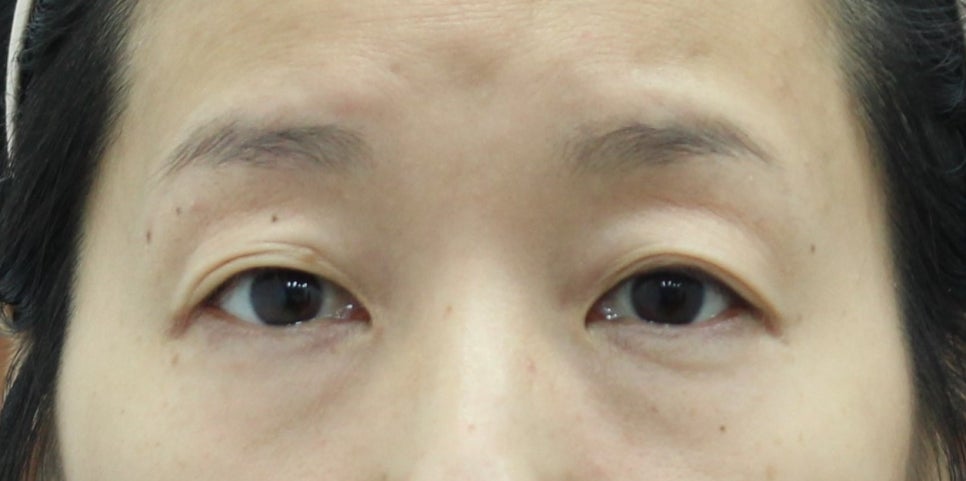 Can People in Their 50s Have Non-Incisional Double Eyelid Surgery? A Natural Look Without Skin Excision image 2