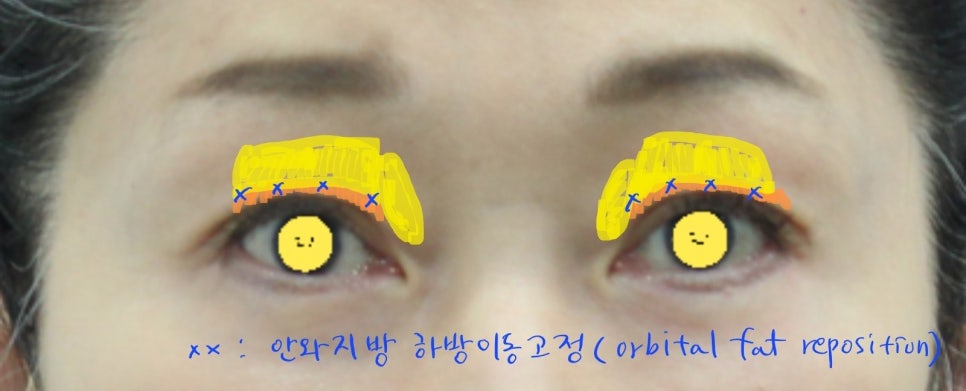 Upper Eyelid Surgery with Upper Eyelid Fat Repositioning image 5