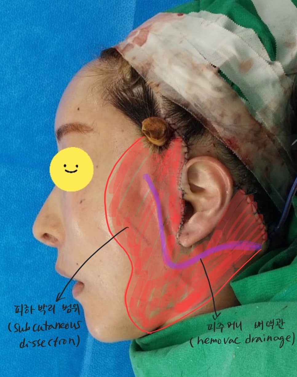 안면윤곽 수술 후 피부처짐의 치료 관련 이미지 5