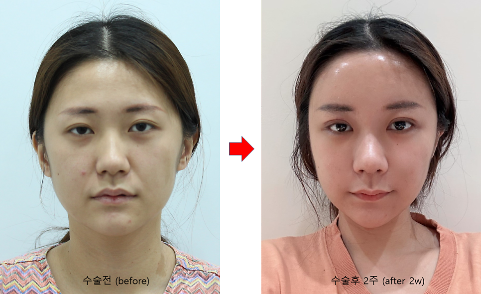 20~30대 종합성형 수술순서와 회복기간 관련 이미지 3