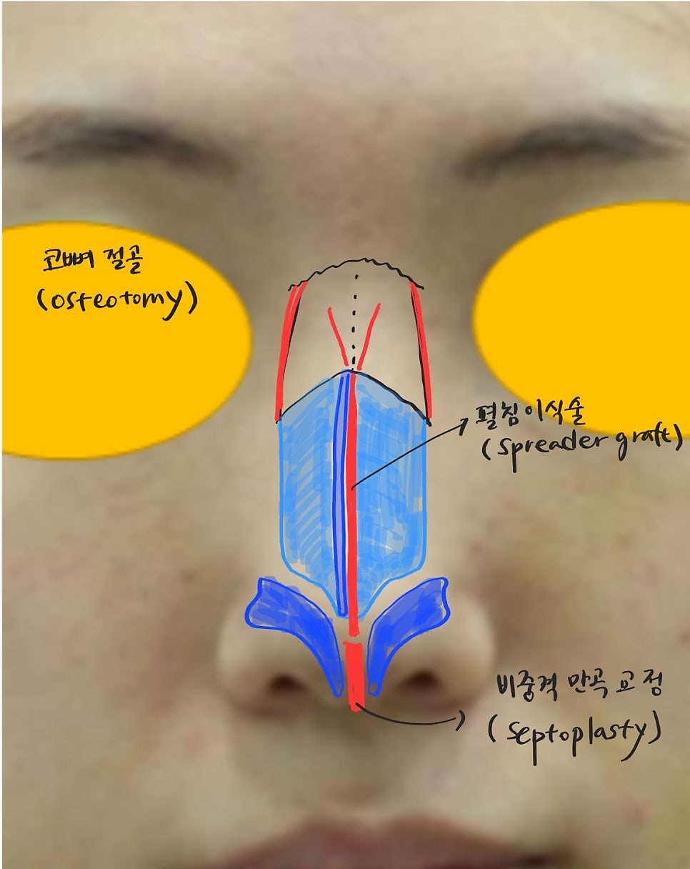 Various Surgical Methods for Crooked Nose Surgery image 4