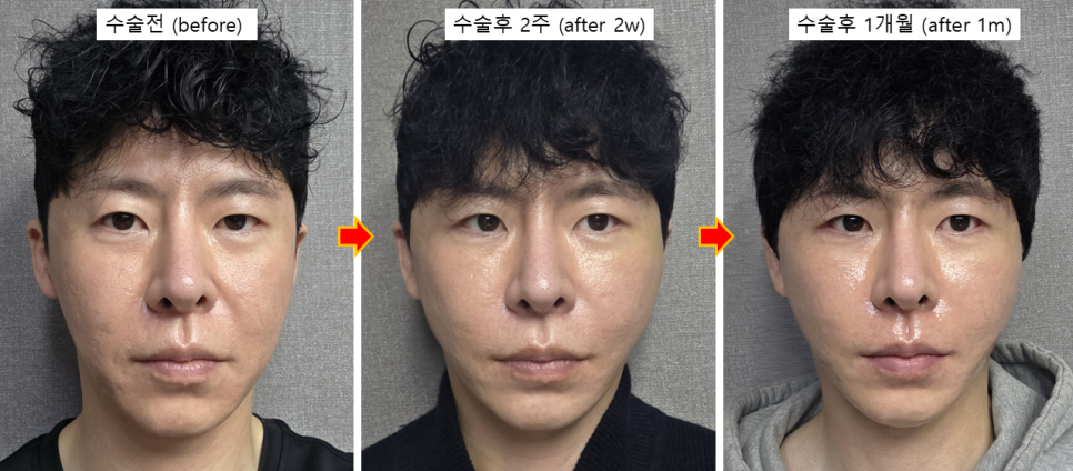 남자 안면거상, 구렛나루를 지키는 것이 중요한 이유 관련 이미지 5